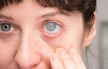 Cườm nước (Glaucoma)